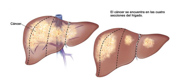 Cirugía de cáncer de hígado