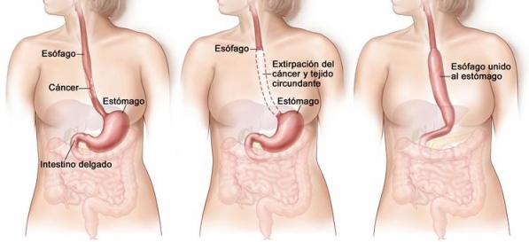 Cáncer de Esófago