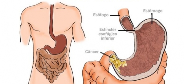 Cáncer de Estómago