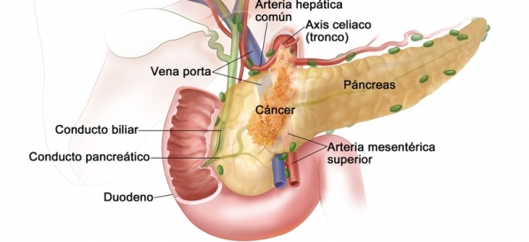 Cirugía de cáncer de páncreas en Chile