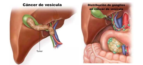 Colecistectomía Radical