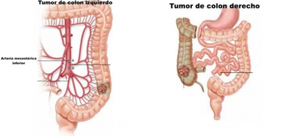 Colectomia Oncológica - Cáncer de Colon