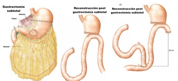 Gastrectomí­a Subtotal Oncológica