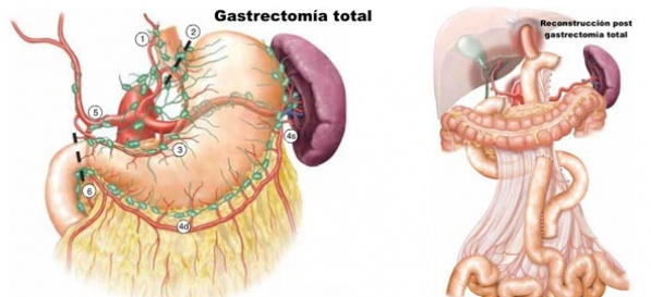 Gastrectomía Total Oncológica