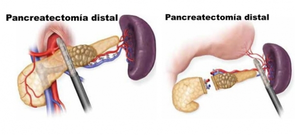 Pancreatectomía distal