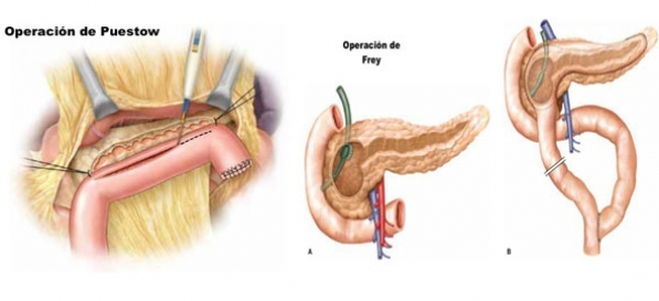 Pancreatitis Crónica