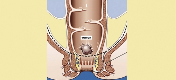 Resección por cáncer de recto