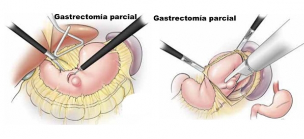 Resección Gástrica Parcial