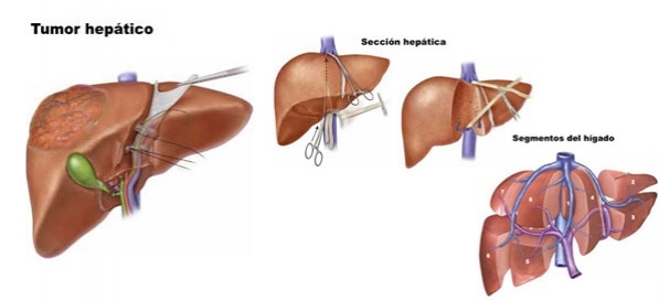 Resección Hepática