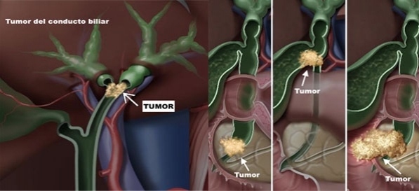 Reseccion de via biliar